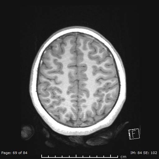 Balo concentric sclerosis (Radiopaedia 61637-69636 Axial T1 69).jpg