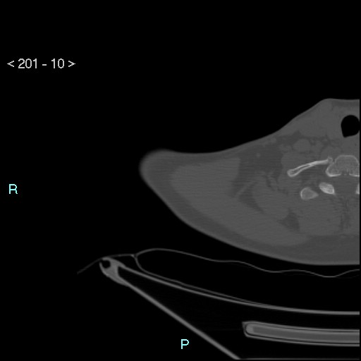 File:Bankart lesion with glenoid bone defect - assessment TC with PICO method (Radiopaedia 42855-93901 Axial bone window 9).jpg