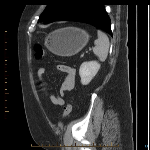 Bariatric balloon causing gastric outlet obstruction (Radiopaedia 54449-60672 C 17).jpg