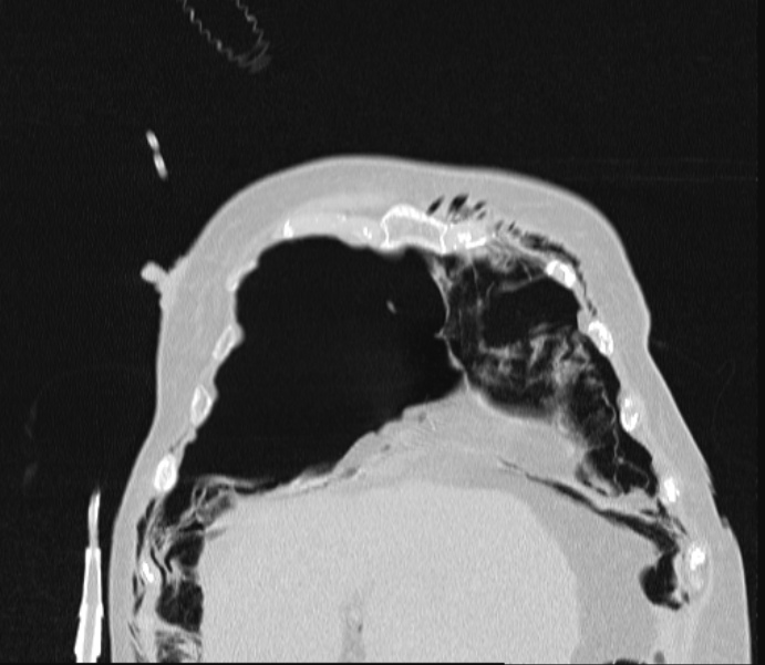 Barotrauma due to mechanical ventilation (Radiopaedia 28079-28336 Coronal lung window 19).jpg