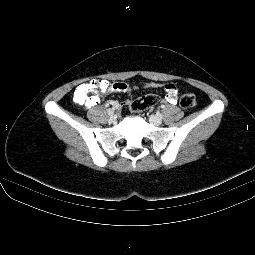 File:Bartholin gland cyst (Radiopaedia 62635-70930 Axial Post contrast 21).jpg