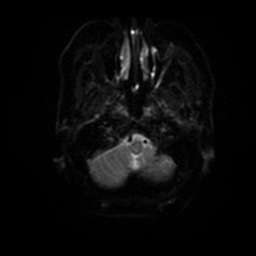 File:Basal cell carcinoma (periorbital) (Radiopaedia 55179-61559 Axial DWI 25).jpg