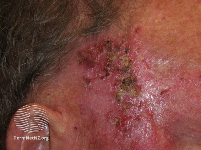Basal cell carcinoma affecting the face (DermNet NZ lesions-bcc-face-0674).jpg