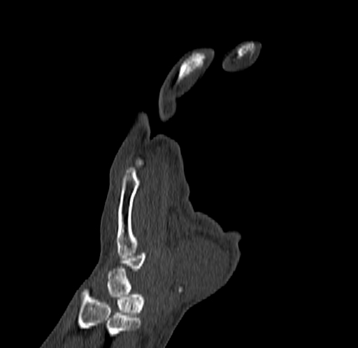 Base of 2nd metacarpal fracture (Radiopaedia 73741-84544 Coronal bone window 31).jpg