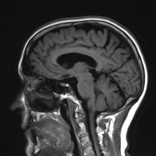 File:Base of skull chondrosarcoma (Radiopaedia 30410-31070 Sagittal T1 11).jpg