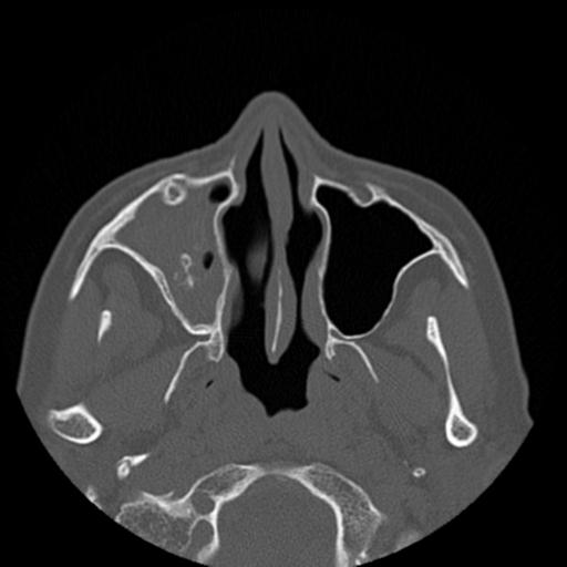File:Base of skull chondrosarcoma (Radiopaedia 30410-31071 Axial bone window 13).jpg
