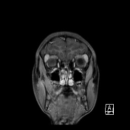 Base of skull rhabdomyosarcoma (Radiopaedia 32196-33142 I 20).jpg