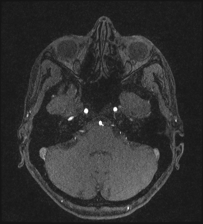 Basilar artery perforator aneurysm (Radiopaedia 82455-97733 Axial MRA 63).jpg