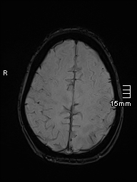 Basilar artery perforator aneurysm (Radiopaedia 82455-99523 Axial SWI 52).jpg