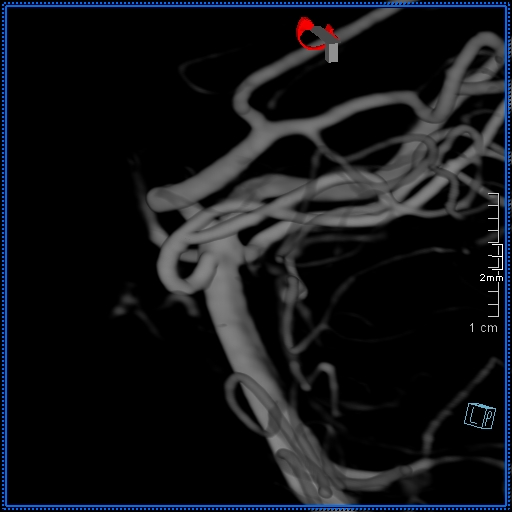 Basilar artery perforator aneurysm (Radiopaedia 82455-99524 3D Left VA 14).jpg