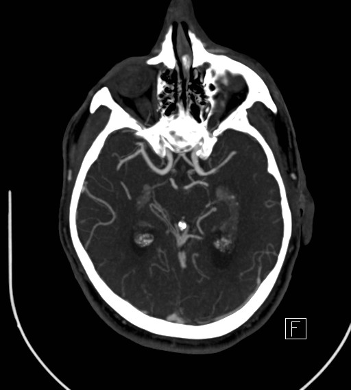Basilar artery thrombosis (Radiopaedia 26986-27163 A 41).jpg