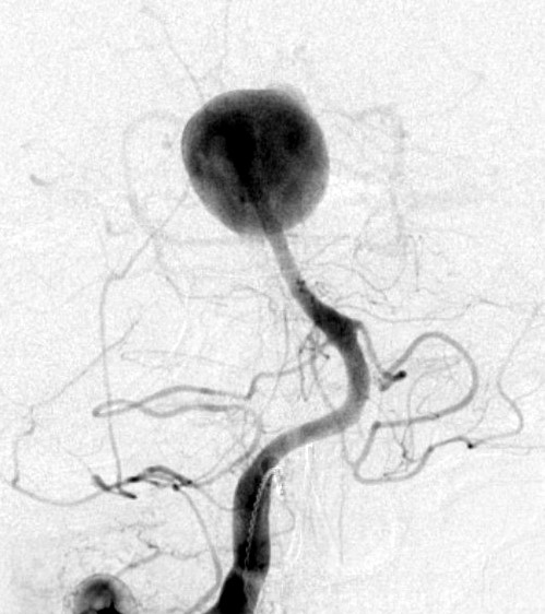 File:Basilar tip aneurysm (Radiopaedia 35969).jpg