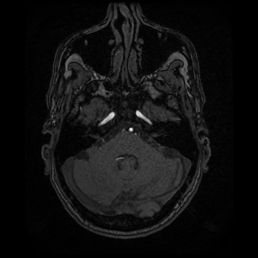 Basilar top and left middle cerebral artery aneurysm (Radiopaedia 61965-70031 Axial MRA 32).jpg
