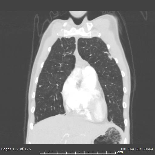 Behçet disease (Radiopaedia 44247-47889 Coronal lung window 50).jpg