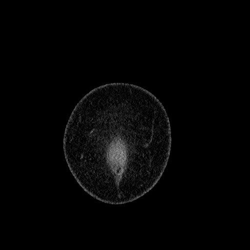File:Benign leiomyoma with hydropic features (Radiopaedia 89250-106130 B 2).jpg