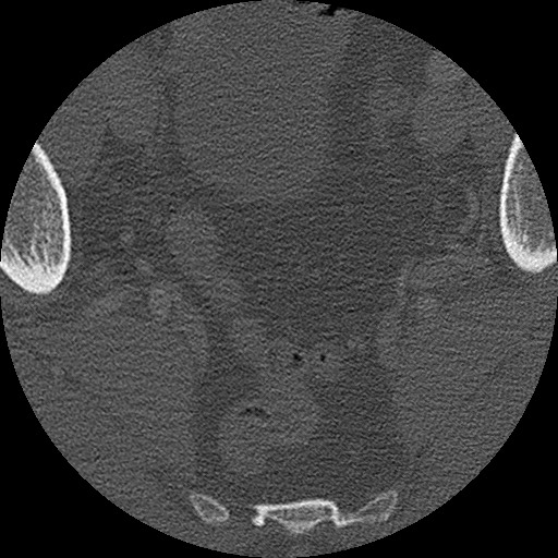 Benign post-traumatic pseudopneumoperitoneum (Radiopaedia 71199-81495 Axial bone window 310).jpg