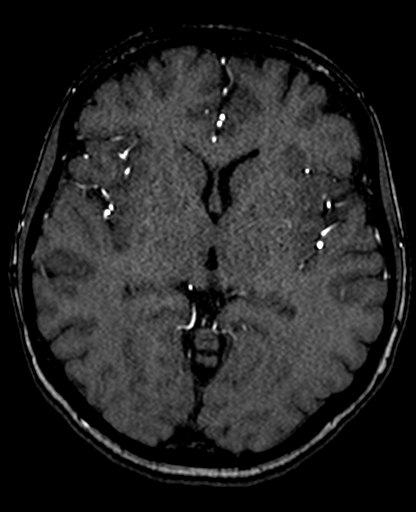 File:Berry aneurysm of the terminal internal carotid artery (Radiopaedia 88286-104918 Axial TOF 124).jpg