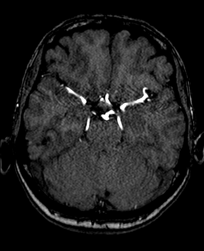 File:Berry aneurysm of the terminal internal carotid artery (Radiopaedia 88286-104918 Axial TOF 97).jpg