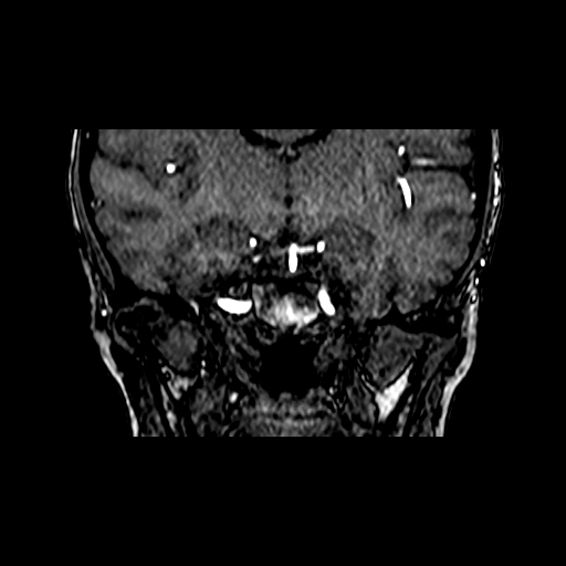 Berry aneurysm of the terminal internal carotid artery (Radiopaedia 88286-104918 Coronal TOF 48).jpg