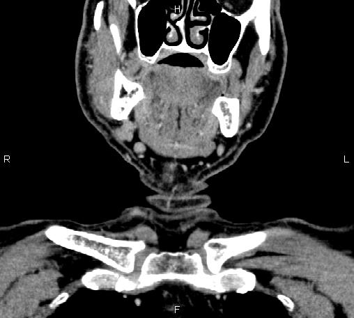 File:Bilateral Warthin tumors (Radiopaedia 84034-99263 C 13).jpg