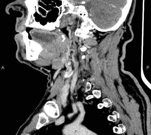 Bilateral Warthin tumors (Radiopaedia 84034-99263 D 50).jpg