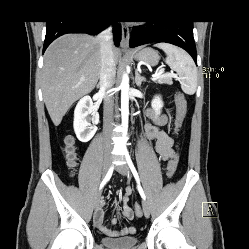 File:Bilateral accessory renal arteries with mild pelvi-ureteric junction (PUJ) obstruction (Radiopaedia 66357-75596 B 20).jpg