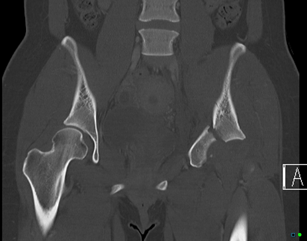 File:Bilateral acetabular fractures (Radiopaedia 79272-92308 Coronal bone window 18).jpg