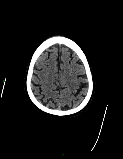 Bilateral acute middle cerebral artery territory infarcts (Radiopaedia 77319-89401 Axial non-contrast 70).jpg