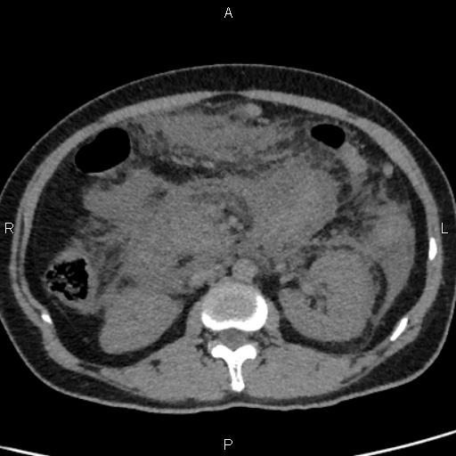 Bilateral adrenal gland hyperenhancement in pancreatitis (Radiopaedia 86642-102753 Axial non-contrast 50).jpg