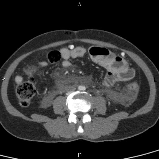 Bilateral adrenal gland hyperenhancement in pancreatitis (Radiopaedia 86642-102753 E 68).jpg