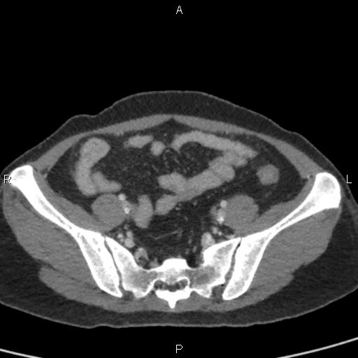 Bilateral adrenal gland hyperenhancement in pancreatitis (Radiopaedia 86642-102753 E 88).jpg