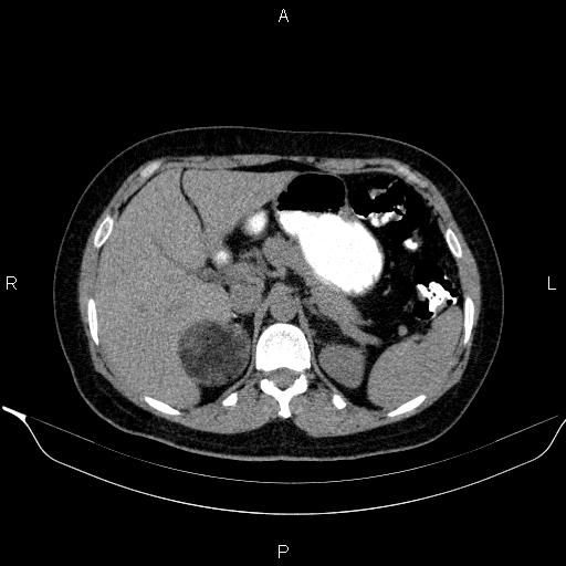 File:Bilateral adrenal myelolipoma (Radiopaedia 63058-71535 Axial non-contrast 44).jpg