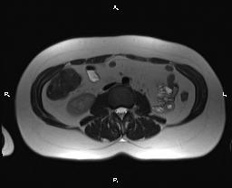 File:Bilateral adrenal myelolipoma (Radiopaedia 63058-71537 Axial T2 24).jpg