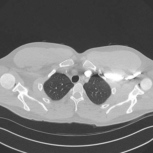 Bilateral atelectasis (Radiopaedia 48666-53675 Axial lung window 13).jpg