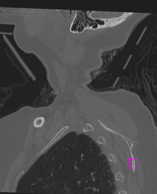 Bilateral atlanto-occipital assimilation (Radiopaedia 28350-28603 Sagittal bone window 2).jpg