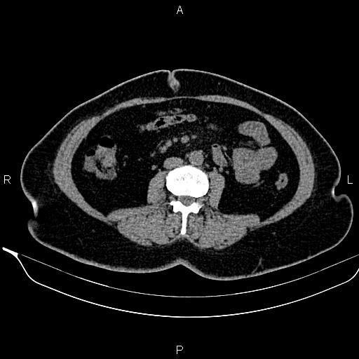 Bilateral benign adrenal adenomas (Radiopaedia 86912-103124 Axial non-contrast 62).jpg