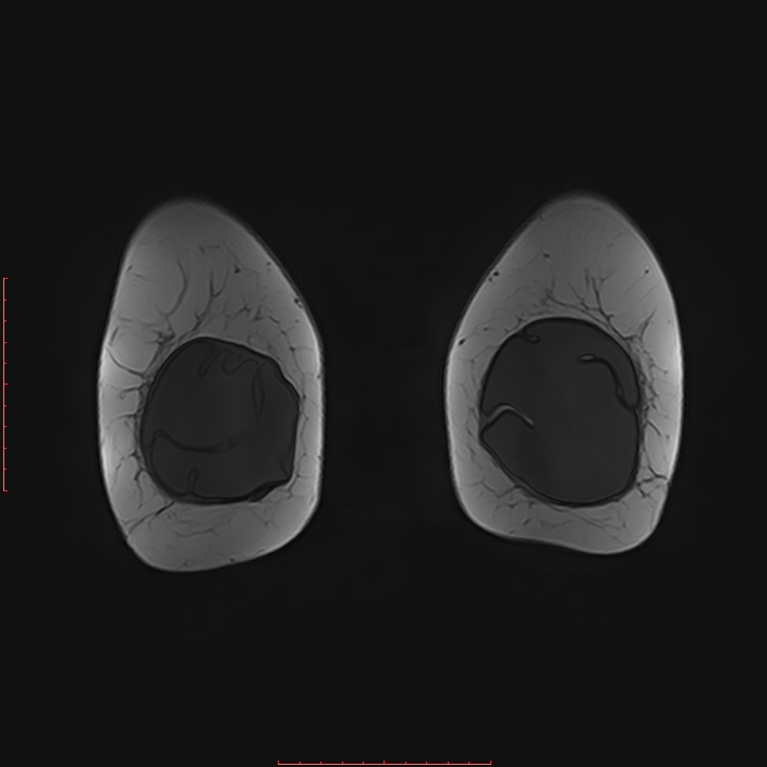 Bilateral breast implant rupture (Radiopaedia 24761-25027 G 90).jpg