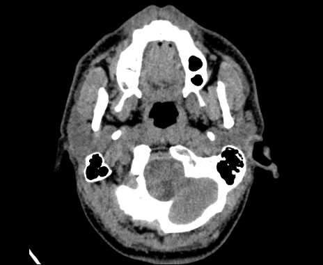 Bilateral carotid body tumors (Radiopaedia 61841-69870 Axial non-contrast 15).jpg