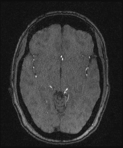 Bilateral carotid body tumors and right glomus jugulare tumor (Radiopaedia 20024-20060 Axial MRA 86).jpg