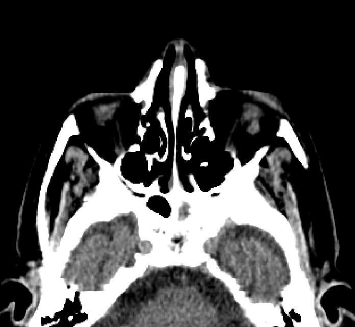 Bilateral ectopia lentis (Radiopaedia 89889-107013 Axial non-contrast 67).jpg