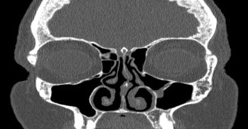 File:Bilateral ectopic infraorbital nerves (Radiopaedia 49006-54084 Coronal 45).png
