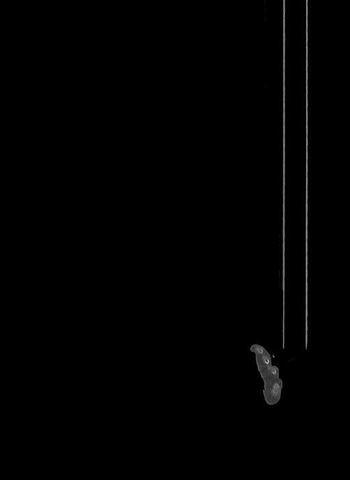 Bilateral fibular hemimelia type II (Radiopaedia 69581-79491 Sagittal bone window 3).jpg