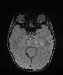 Bilateral mesial temporal polymicrogyria (Radiopaedia 76456-88181 Axial SWI 23).jpg