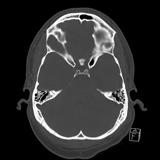 Bilateral occipital condyle fracture (type 2) (Radiopaedia 87675-104089 Axial bone window 40).jpg
