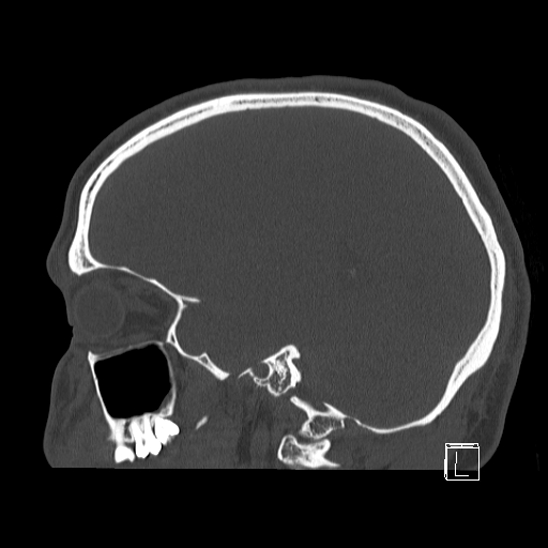 Bilateral occipital condyle fracture (type 2) (Radiopaedia 87675-104089 Sagittal bone window 31).jpg