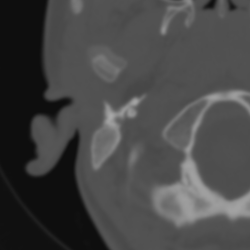 Bilateral otosclerosis (Radiopaedia 57237-64157 B 11).jpg