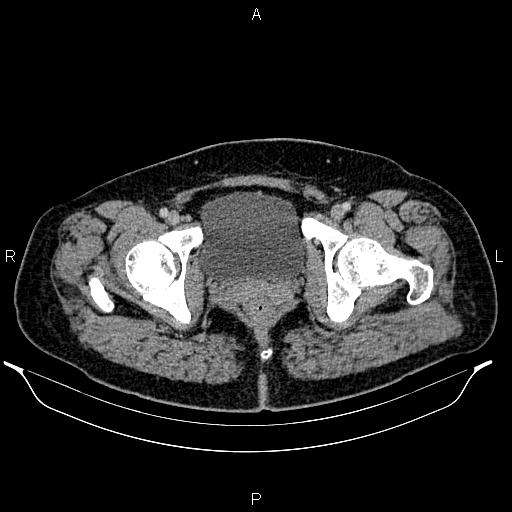 Bilateral ovarian dermoid cysts (Radiopaedia 85785-101603 A 105).jpg