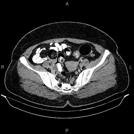 Bilateral ovarian dermoid cysts (Radiopaedia 85785-101603 A 85).jpg