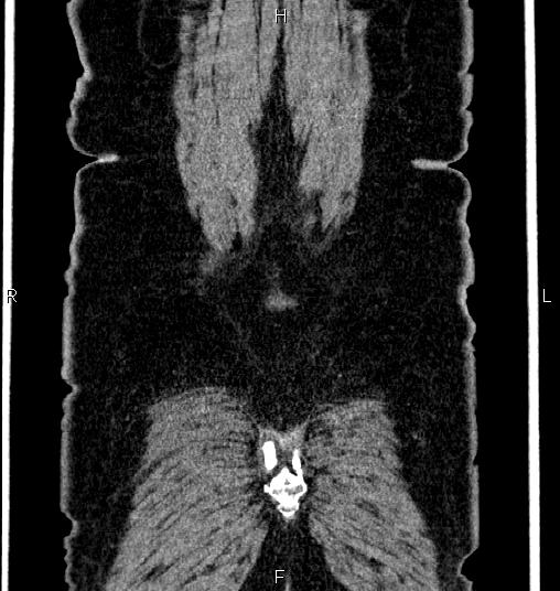 Bilateral ovarian dermoid cysts (Radiopaedia 85785-101603 C 62).jpg