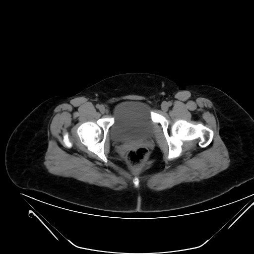 File:Bilateral ovarian mature cystic teratomas (Radiopaedia 79373-92457 Axial non-contrast 87).jpg
